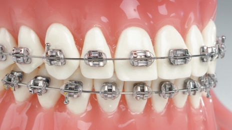 Aparat ortodontyczny stay przyklejany metalowy